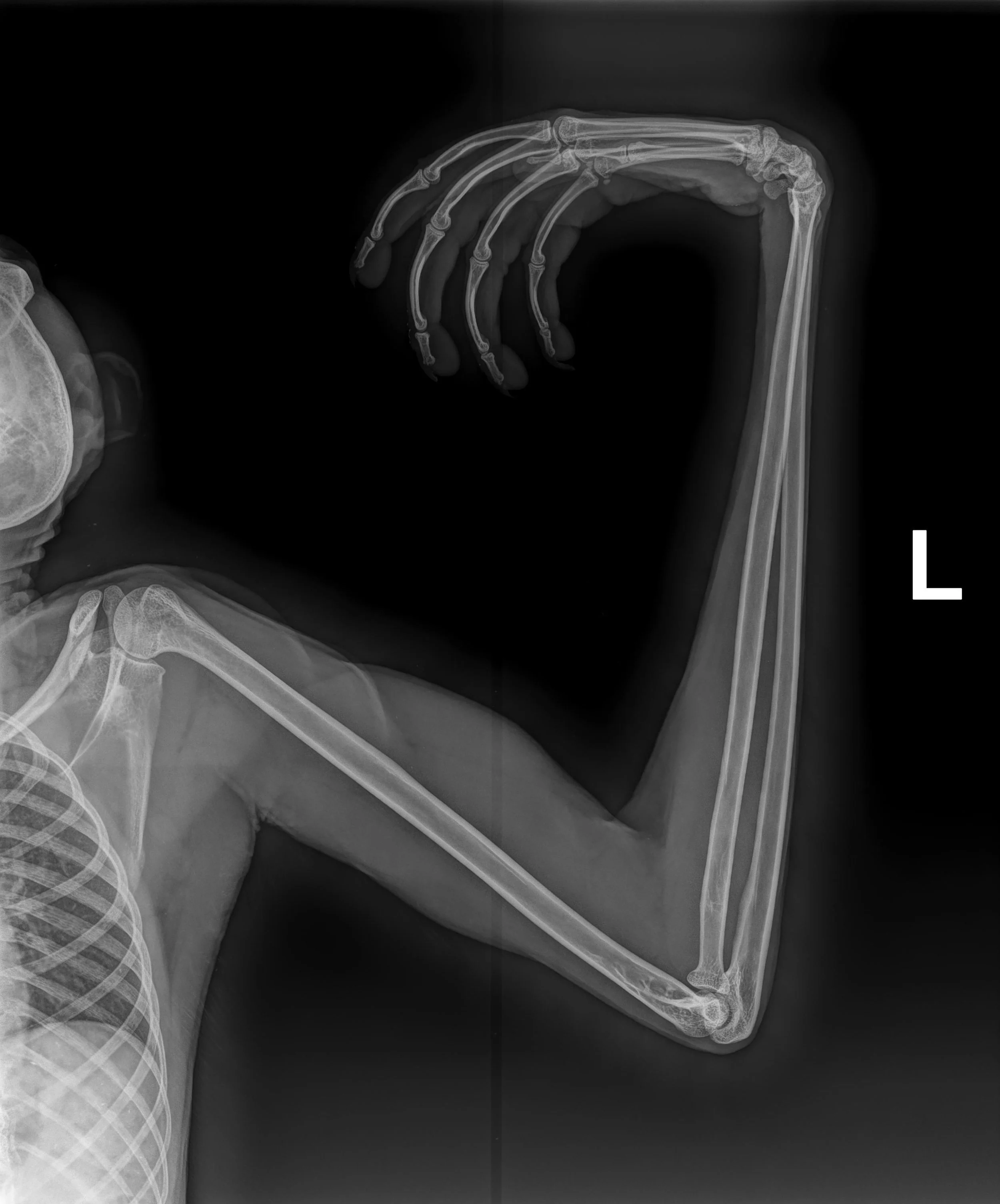 X-ray image of a left arm showing the bones, including the humerus, radius, and ulna, with a flexed elbow.