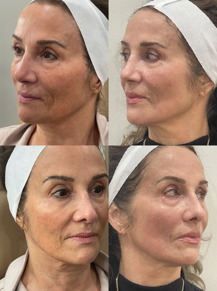 triLift after 5 sessions @ VODA Eyecare, Suwanee, GA