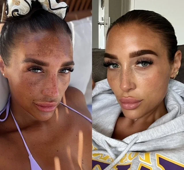What Is Pigmentation - And How Do We Treat It Safely & Effectively?