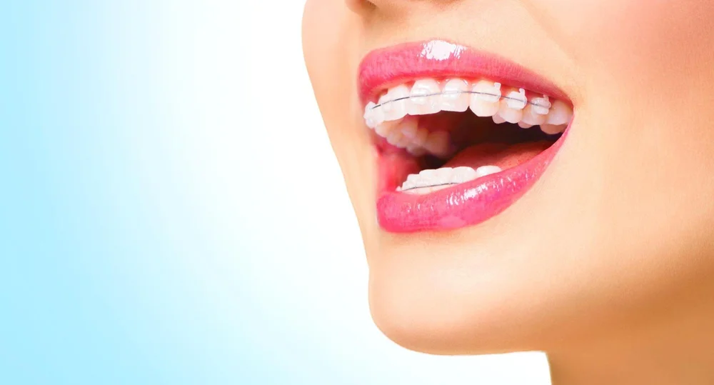 Achieve a Confident Smile with Clear Braces at Orthodontic Arts in ...