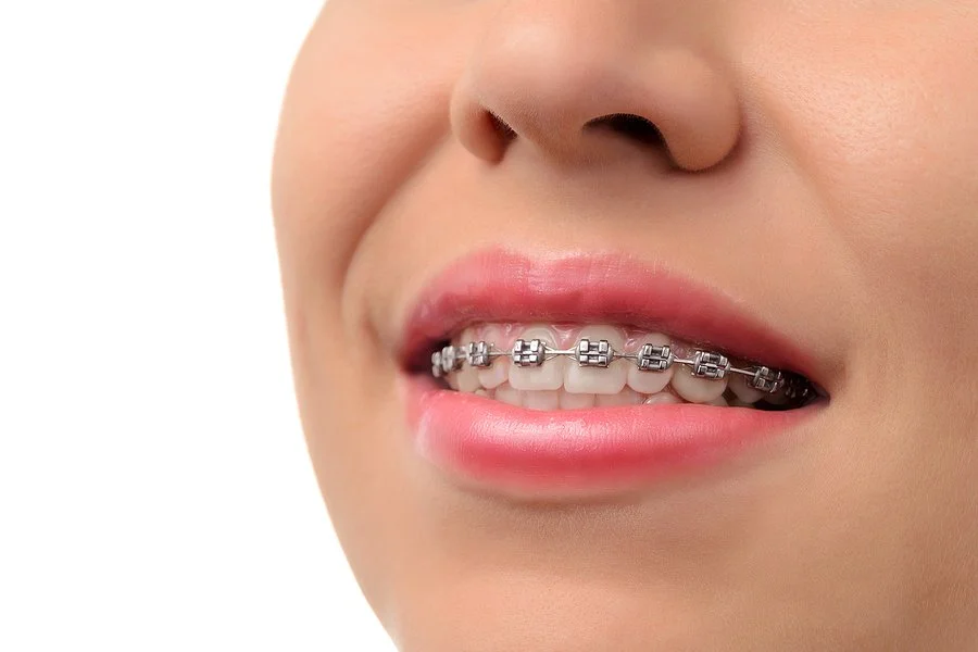 A close-up of a smiling mouth with metal dental braces on the teeth.