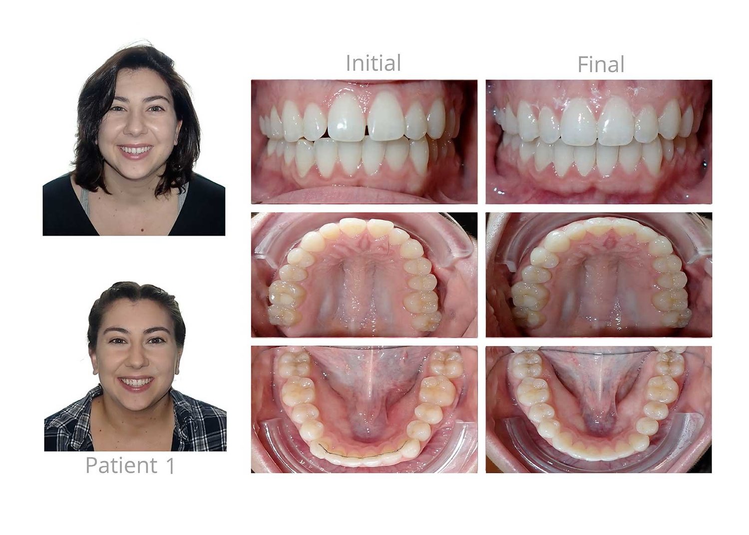 Straighten Your Smile: Nudge, Your Invisalign Alternative — Orthodontic ...