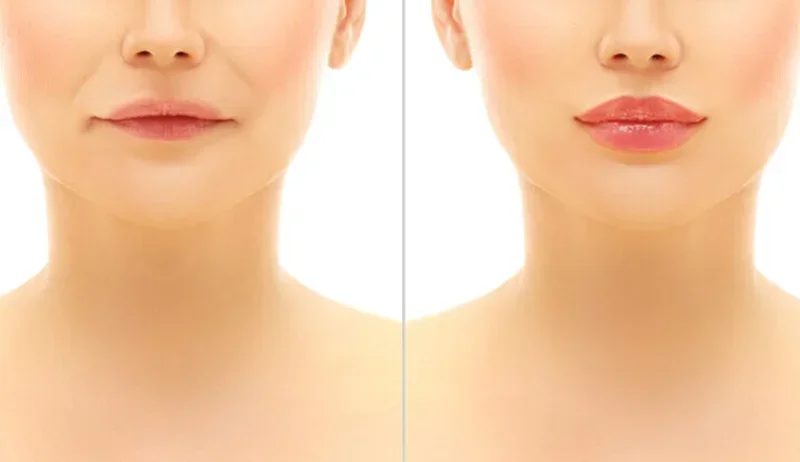 Aftercare Practices for Juvéderm Filler Injections
