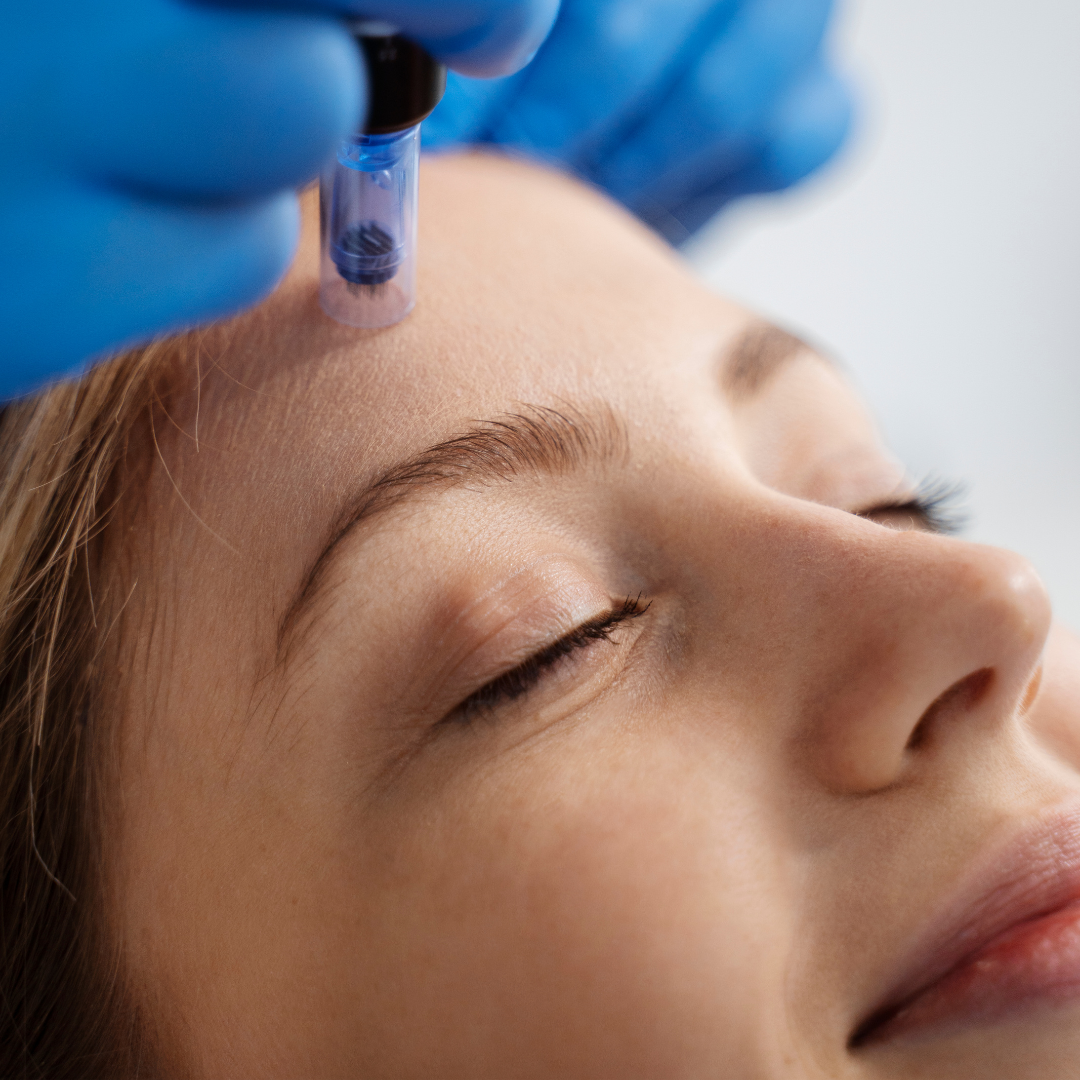 Medspa in Barrington, IL, 60010 l Microneedling Near Me