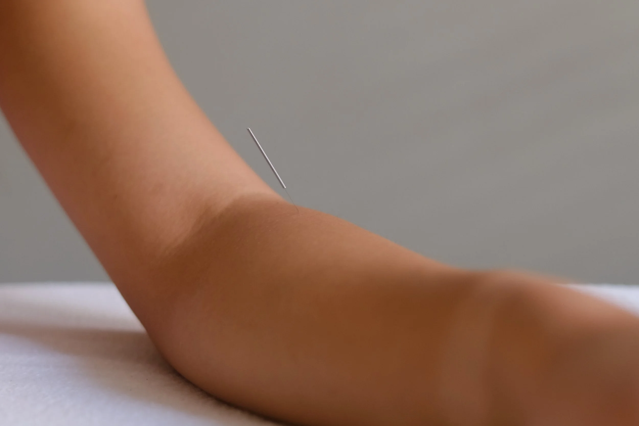 What to Expect During an Acupuncture Treatment