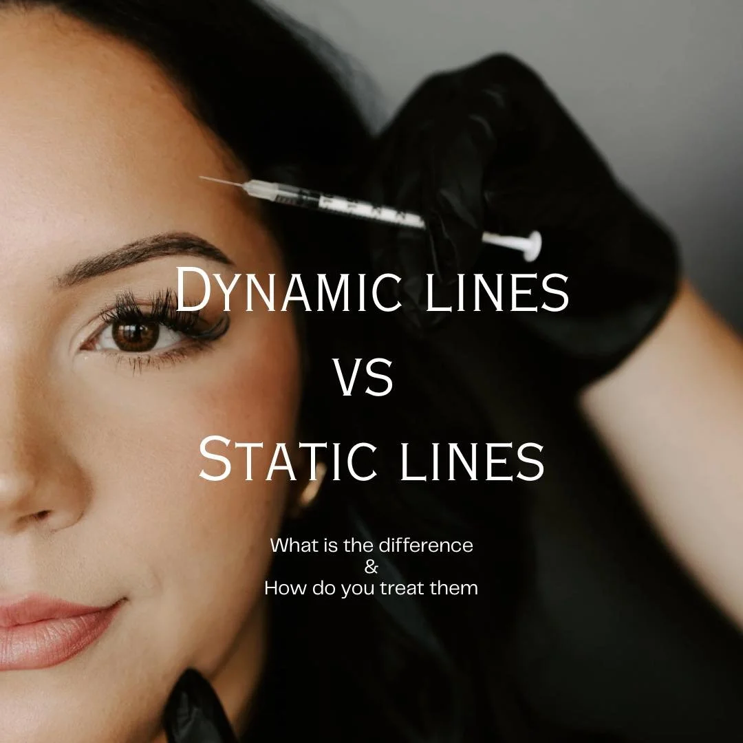 Dynamic lines vs static lines 🖤