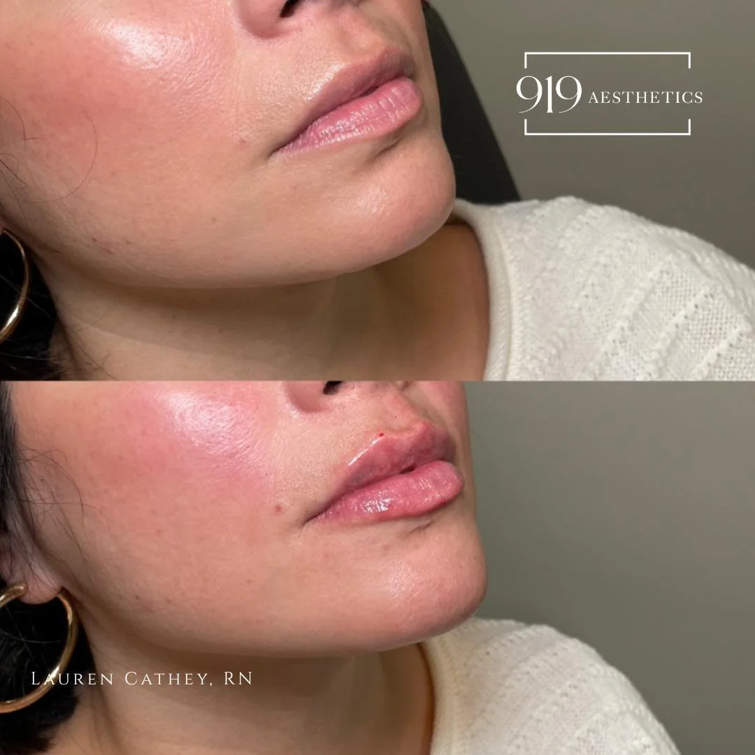 ✨ Another set of soft, natural lips ✨
When placed with precision, lip filler doesn&rsquo;t change who you are &mdash; it enhances the beauty that&rsquo;s already there. My goal with every patient is to highlight your natural anatomy, never distort it