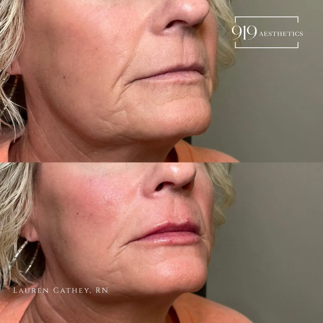 ✨subtle &amp; natural✨
Absolutely loving how these lips turned out! The perfect amount of volume, definition, and  hydration 💋😍
.
🗓️Follow the link in my bio to book your lip filler treatment or consultation!