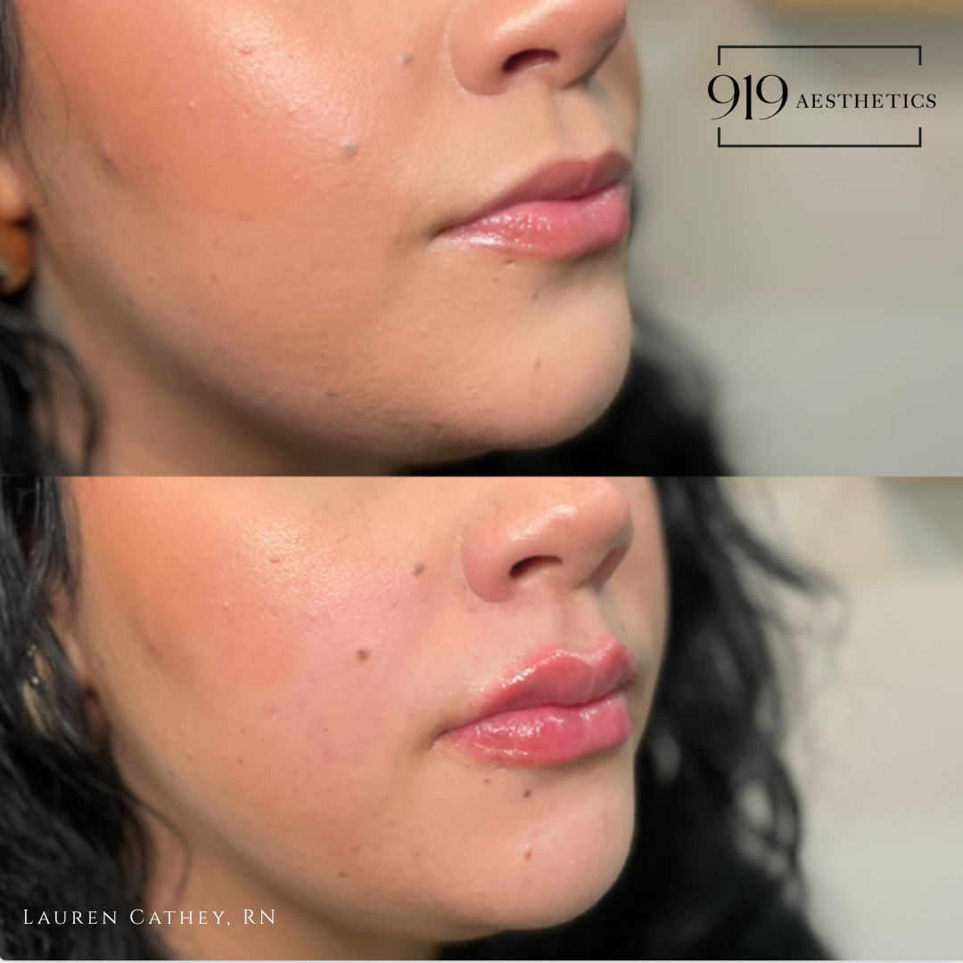 LIP FILLER