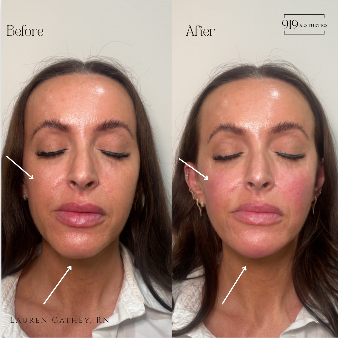 FACIAL BALANCING WITH FLLERS