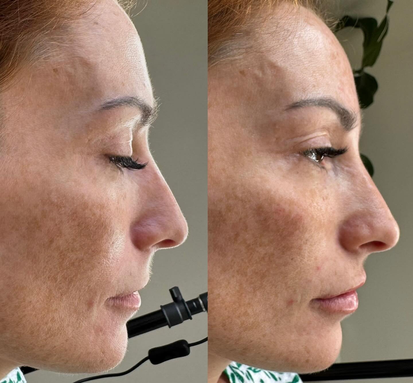 Facial balancing with the smallest amount of filler really does make a difference. Client had a small amount of filler in her cheeks, nasolabial folds and lips. Last picture is clients own before and after #cobhamaesthetics #aestheticssurrey #surreya