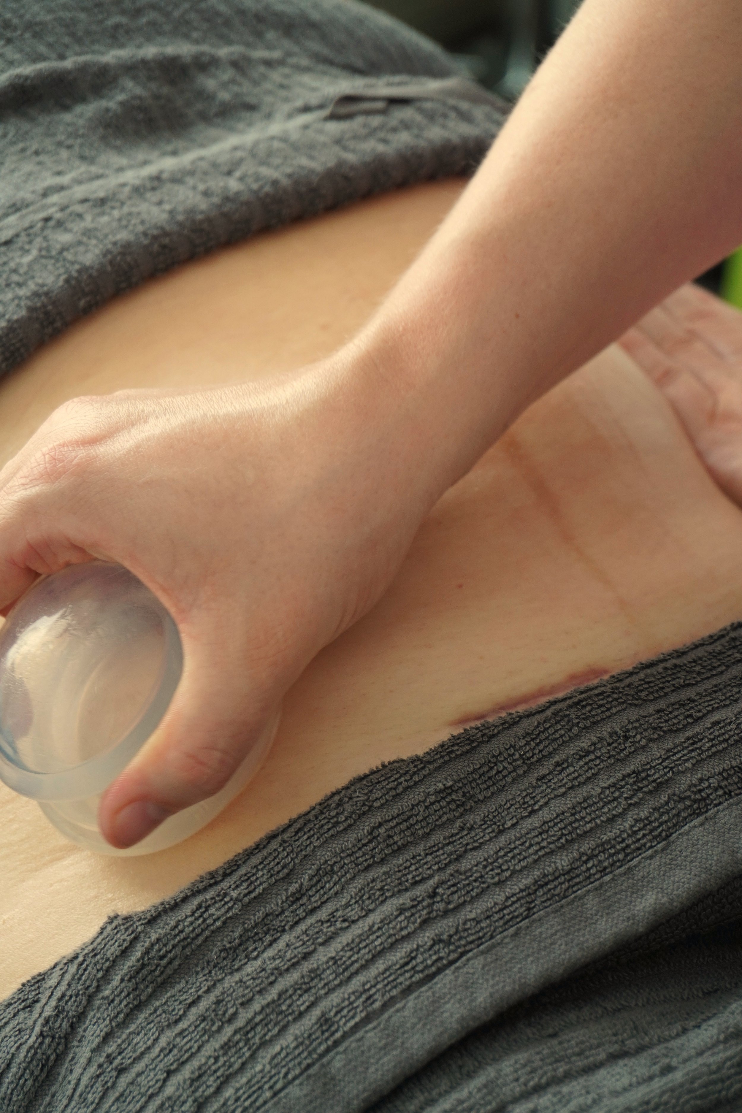 C section scar release therapy in Pakenham