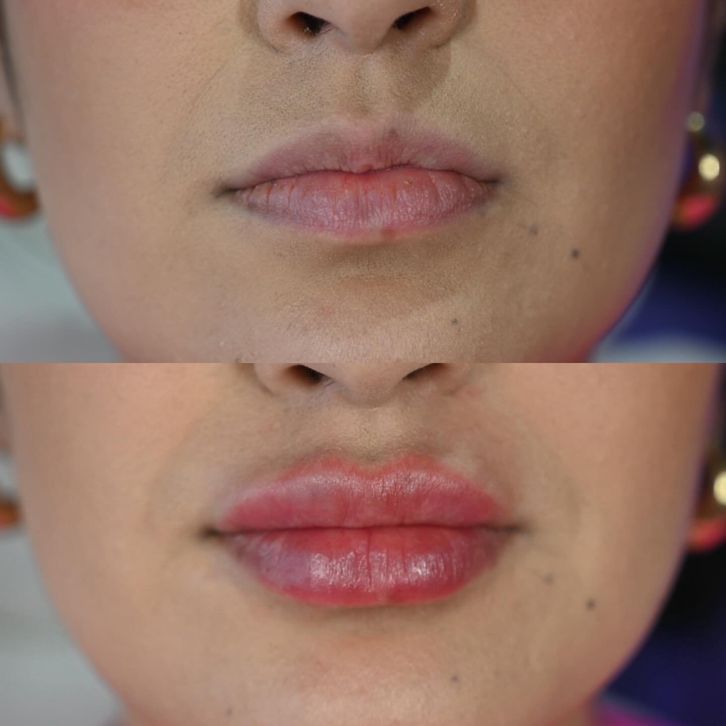 1ml=1 syringe of juicy goodness 🍒💋
We did just enough to enhance her natural shape and give her that pillowy pout ✨

This month book a full syringe for $100 off 💕 
After pay &amp; Klarna accepted😏

#LipFillerGoals #JuicyLips #RevanesseLips #Tulsa