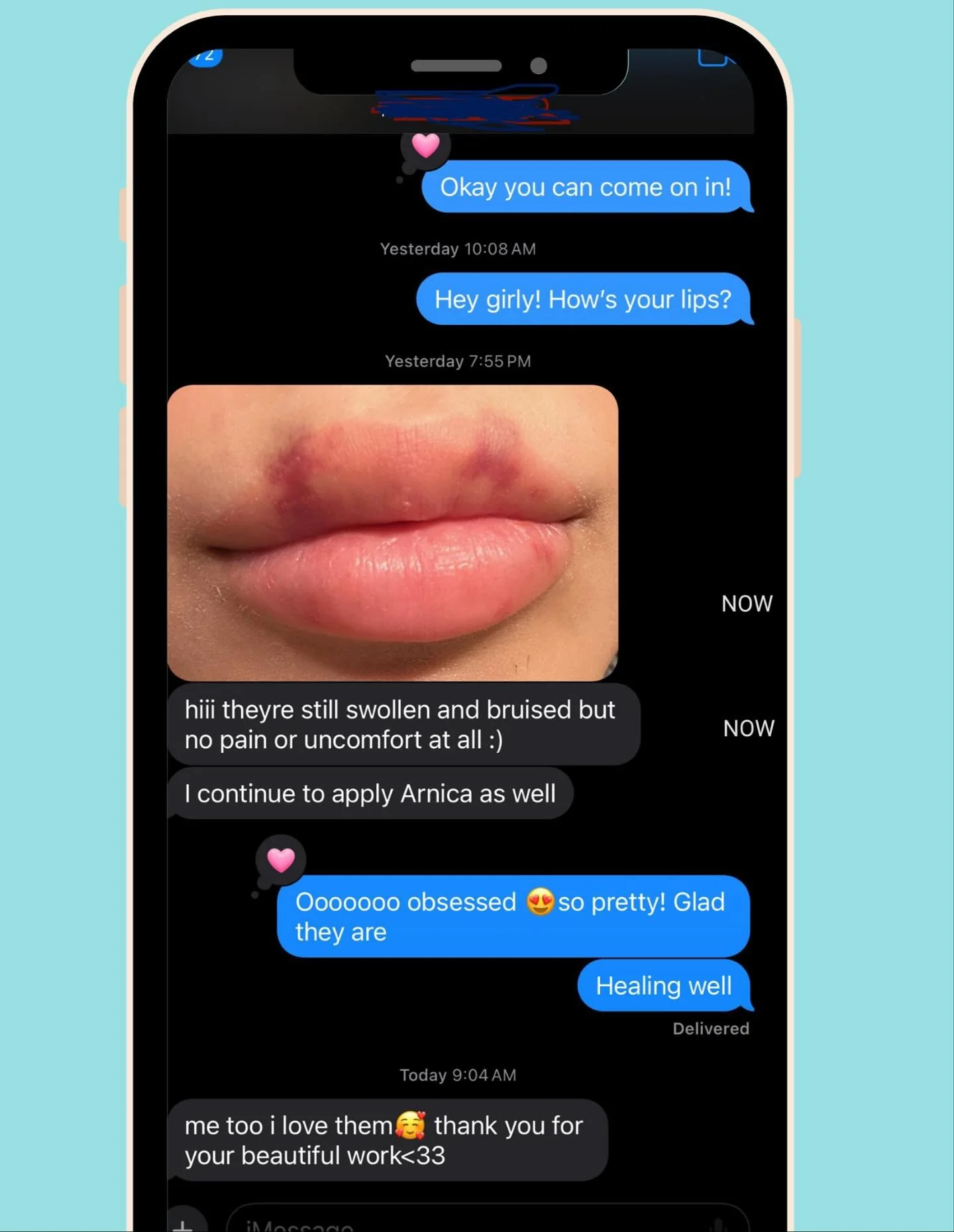 My fav type of response! My clients are the sweetest 💕💕💕

📸 Healing update a few days later:
-Bruising is completely normal and part of the process
-Expect a bit of swelling
-By 2 weeks, healing should be nearly complete

💡 If at 2 weeks you sti