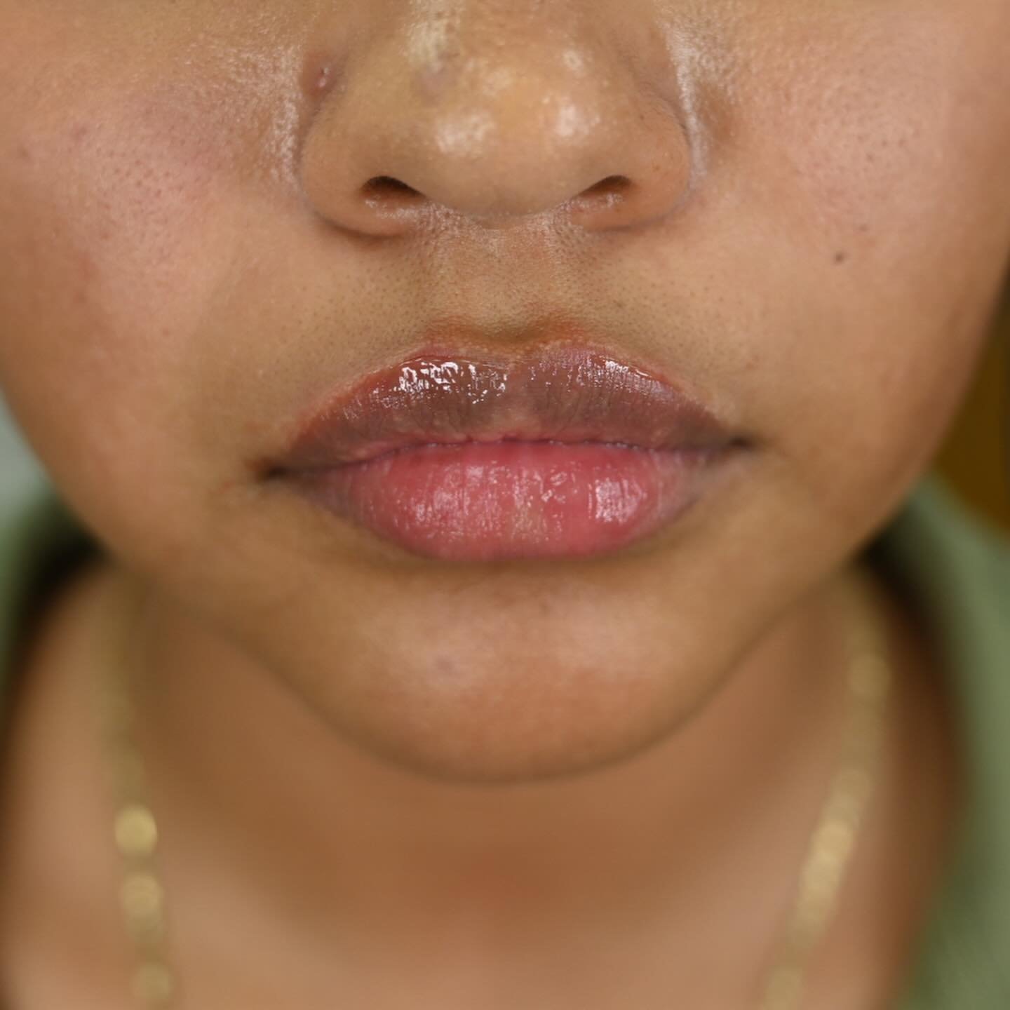 The prettiest pout, perfectly plumped with Versa, chef&rsquo;s kiss every time💓✨

#versa #lipfillertulsa