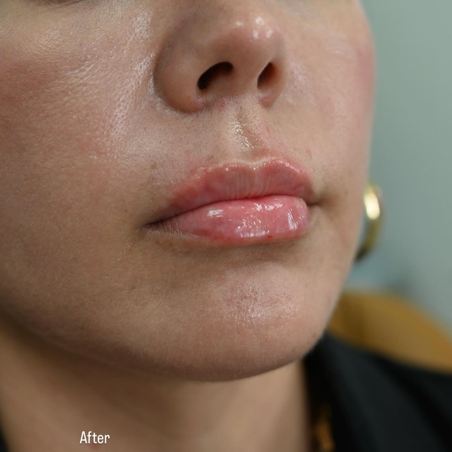 ✨ Some gorgeous lips I did today! She came in with an inspo and left saying they looked exactly how she imagined. Nothing makes me happier than seeing my clients love their results 💋

#lipfillertulsa #lipfiller