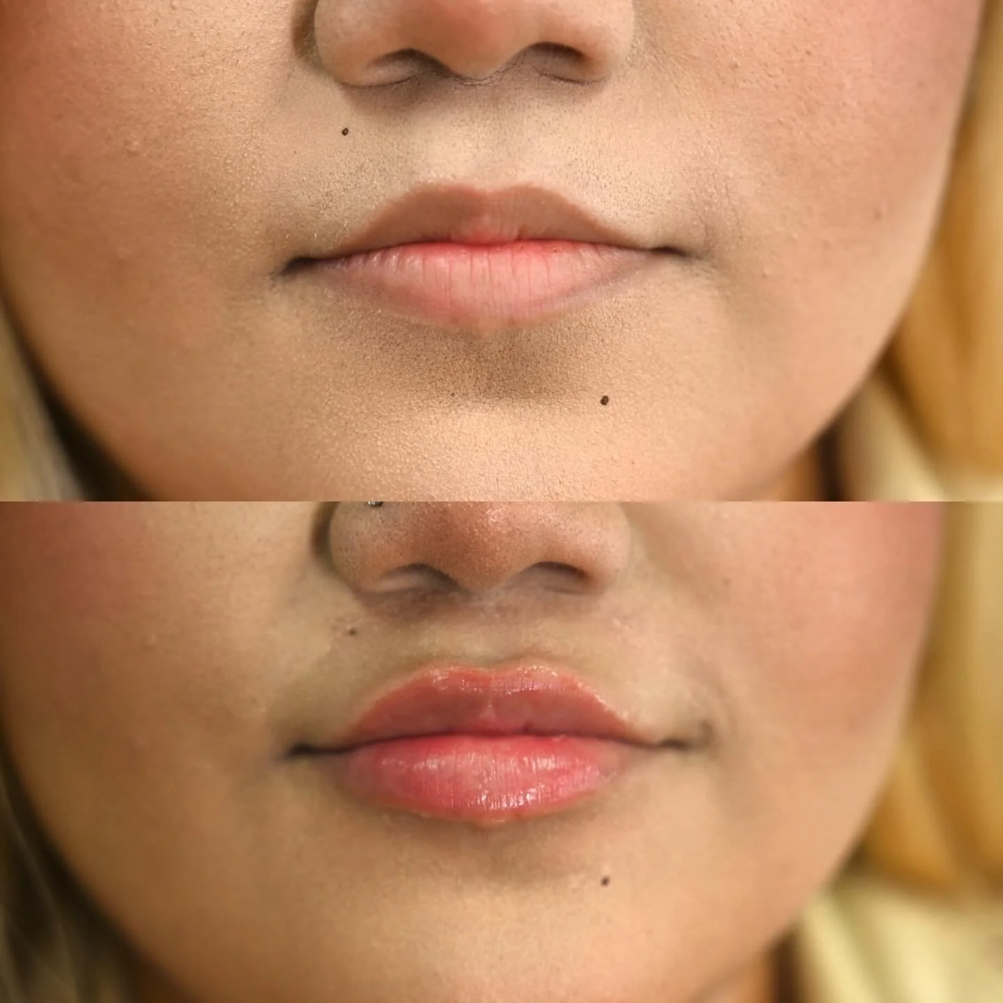 Her goal: Barbie lips 💄💋 We started with 0.7ml in this session and will continue building at her next session. Patience = natural, beautiful results ✨

#lipfiller #barbielips #tulsalipfiller