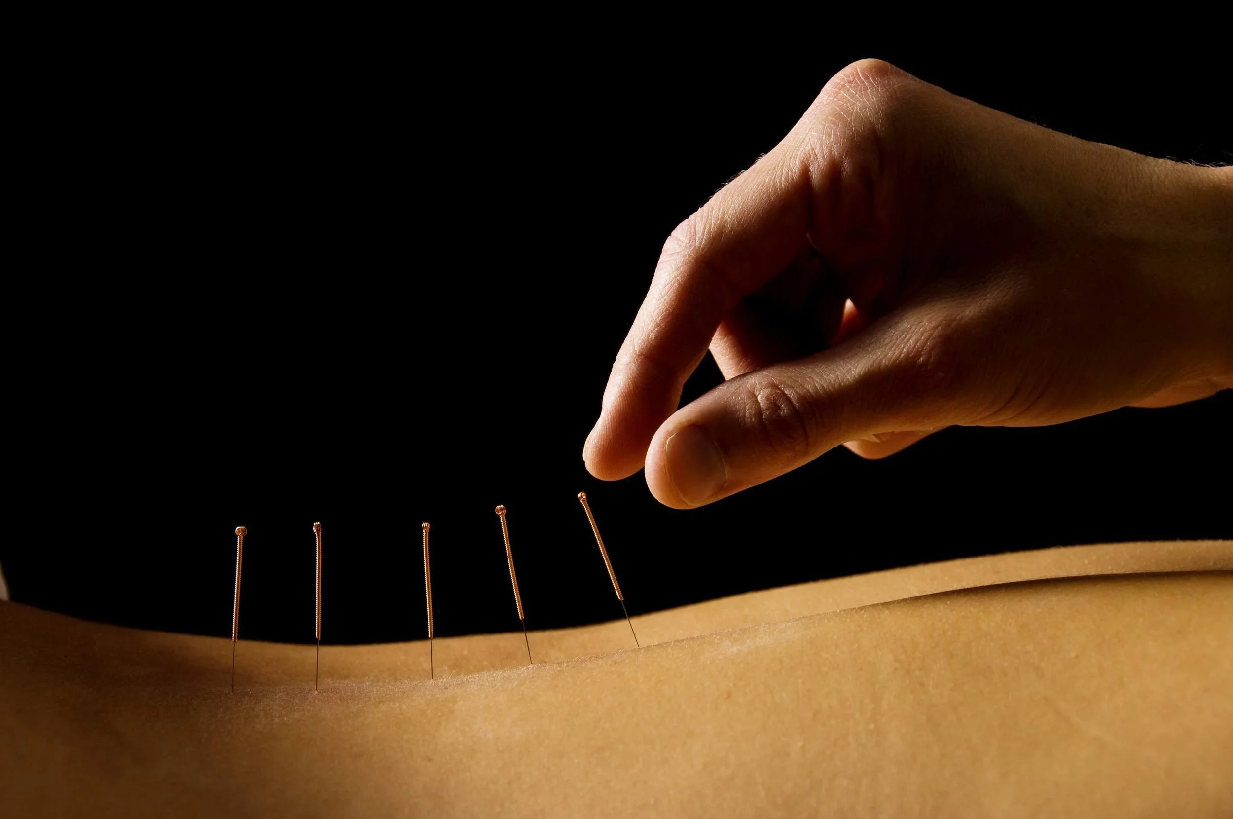 how acupuncture can help with stress and seasonal depression