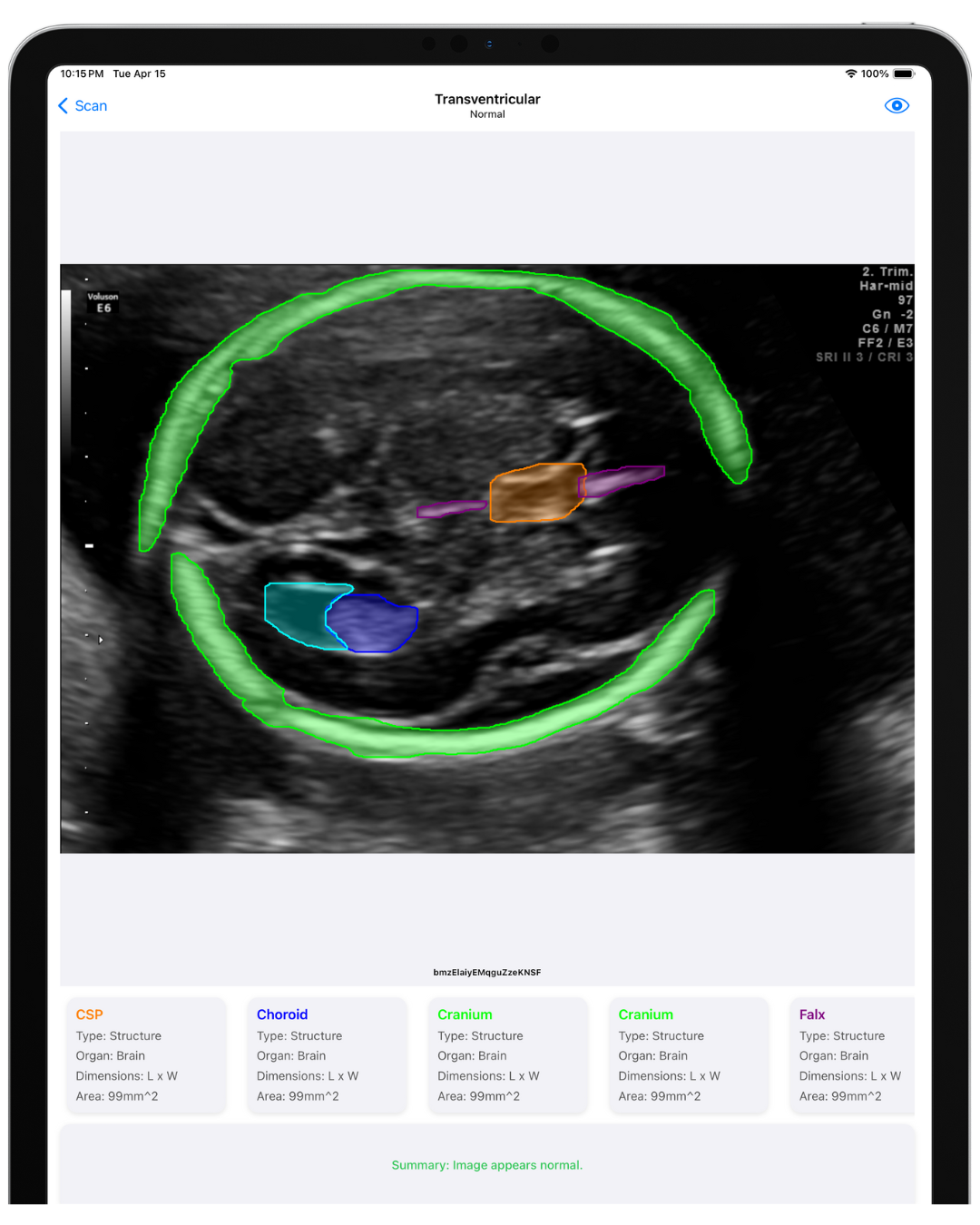 Ultrasound scan of a brain with labeled structures on a tablet, displaying colored outlines for CSP, choroid, cranium, and falx. The screen shows a normal transventricular view.