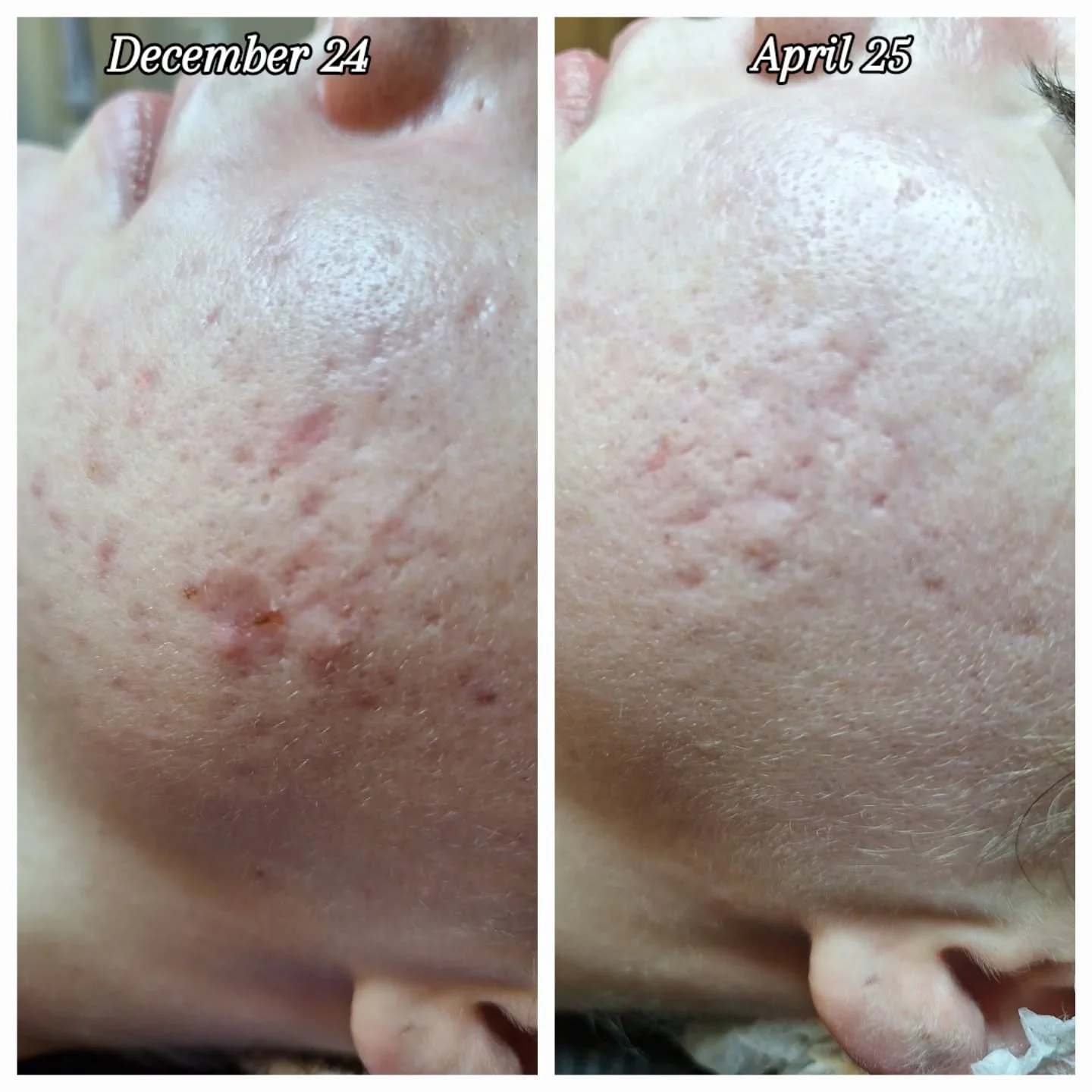 &Scaron;tiri mesece razlike. In prvi cilj je dosežen.

👉Ko se stranka sooča z aktivnim vnetjem, je najprej treba kožo umiriti. 
Brez agresivnih pristopov, s potrpežljivo in dosledno nego &ndash; tako doma kot v salonu. 
&Scaron;ele ko se vnetje umir