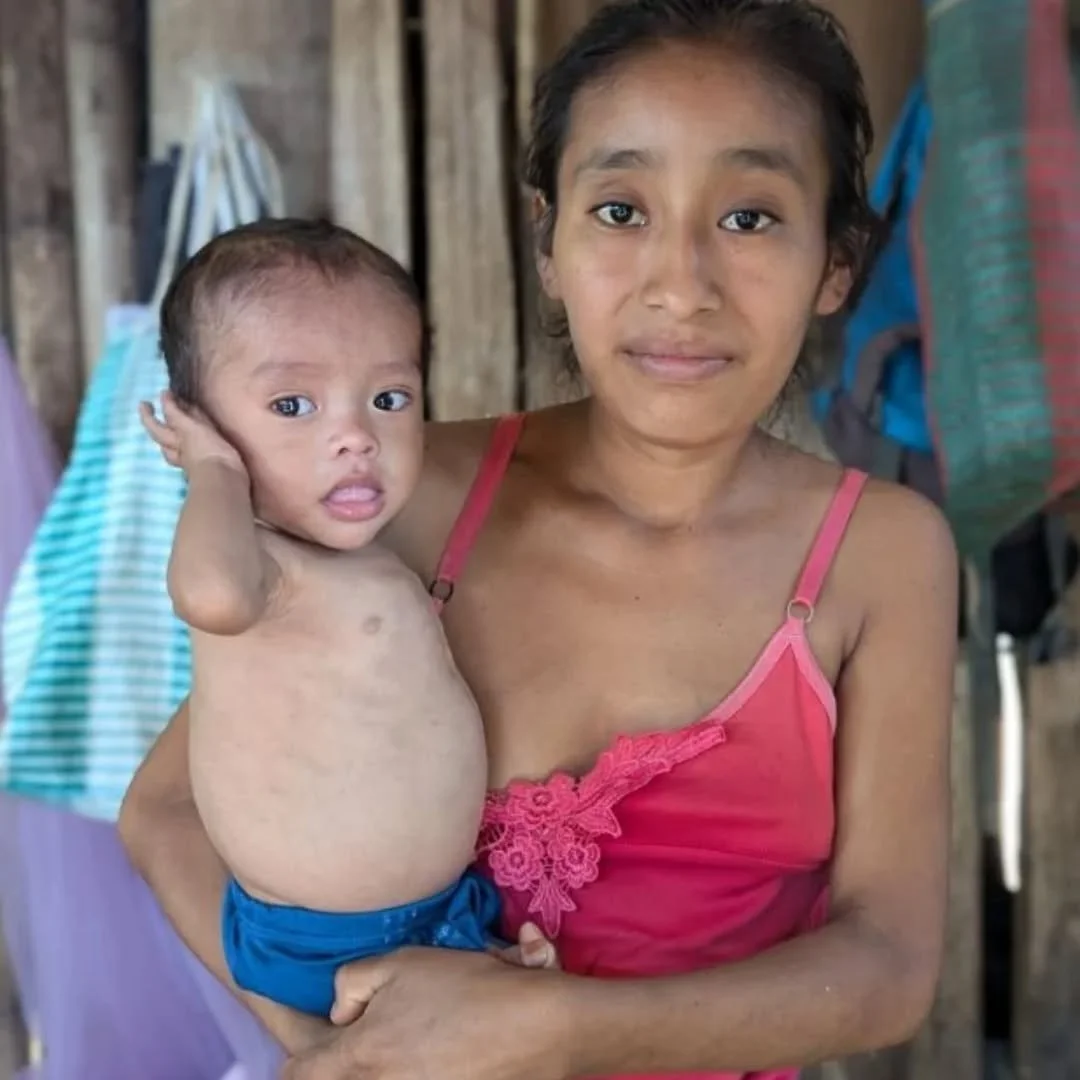 When children are already malnourished, parasites only make things worse. They stop the body from absorbing nutrients and weaken the immune system, which is why children over two need parasite treatment every six months.

Hot weather, heavy rain, and