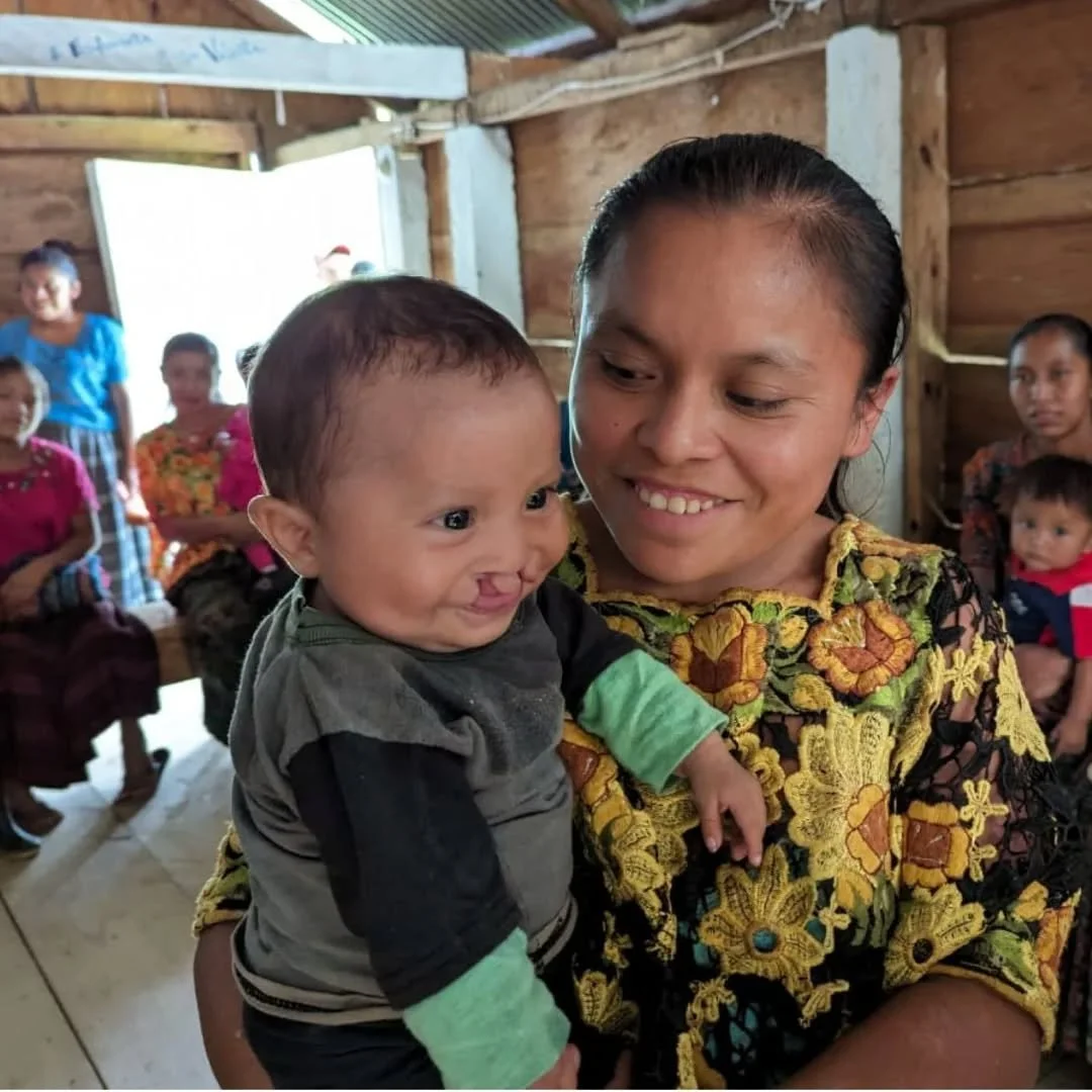 Right from birth, children with cleft lips or palates often face serious feeding challenges, putting them at risk of severe malnutrition. Thankfully, Estevan no longer has to face this difficulty after receiving his surgery - and his parents, Margari