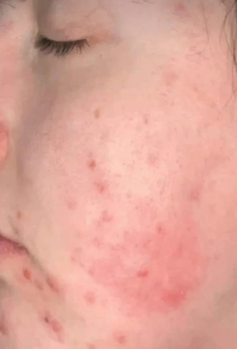 Is your skin barrier damaged?