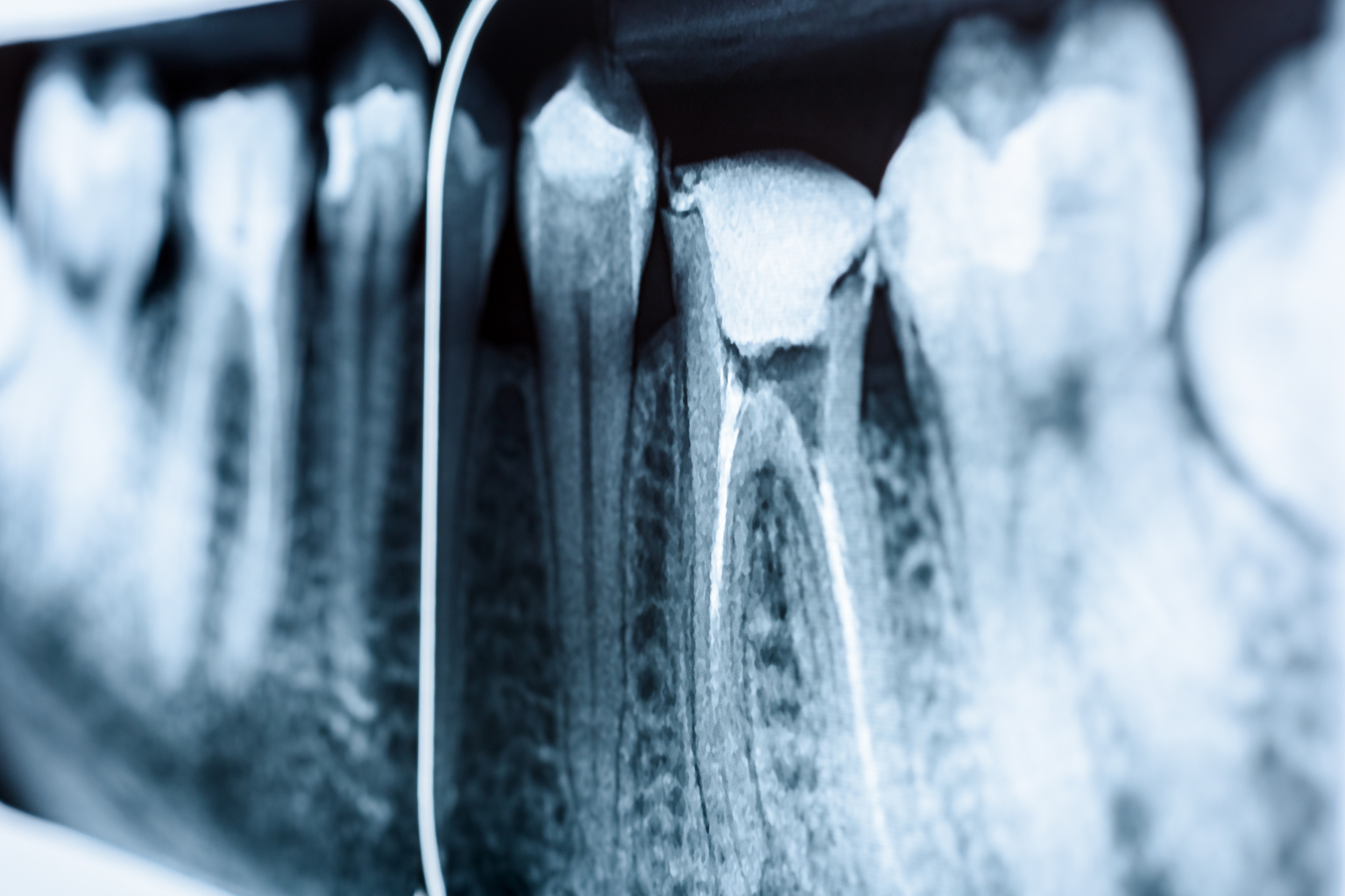 ROOT CANAL — DENTAL DIRECT