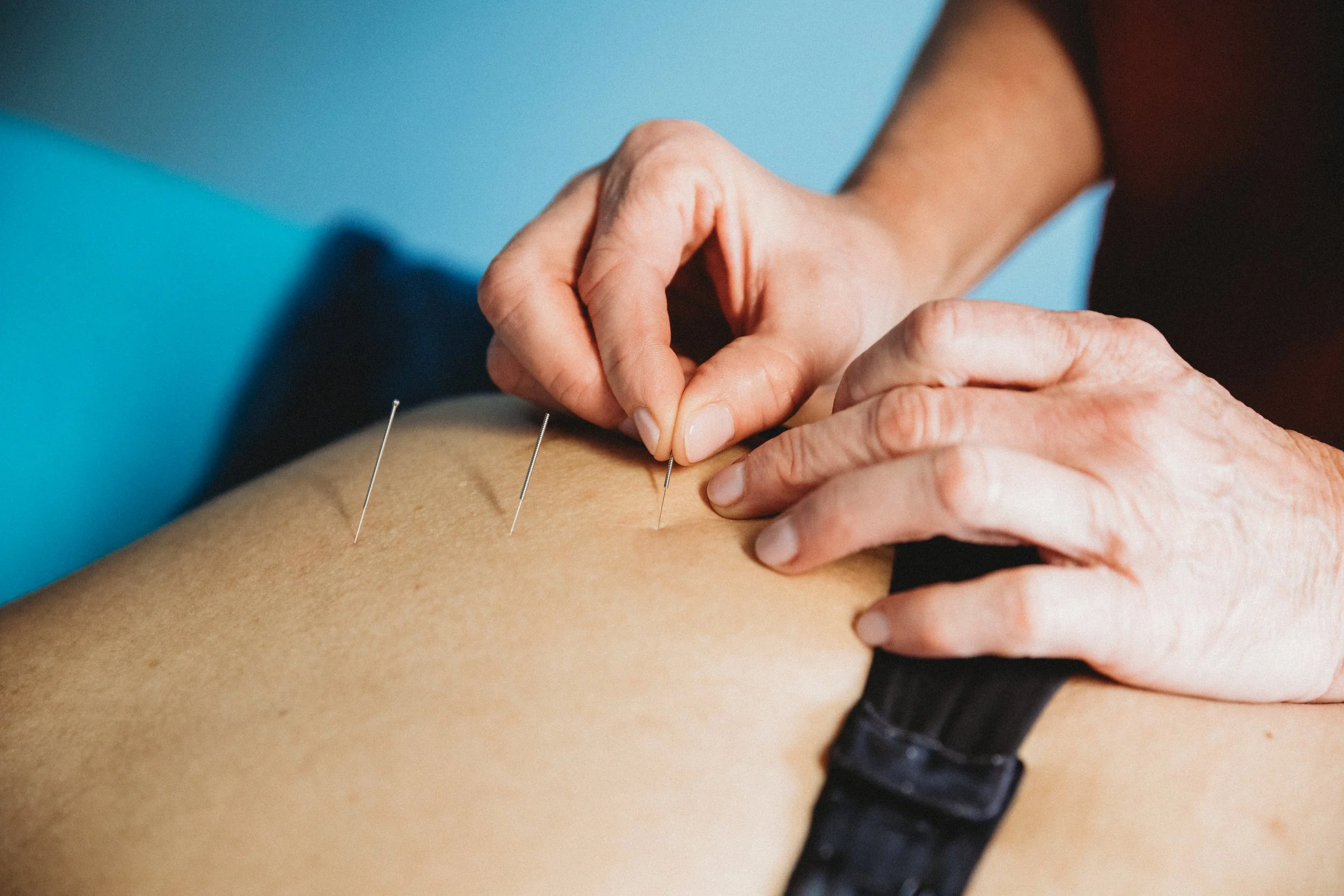 Acupuncture for Healing in the Postpartum Period