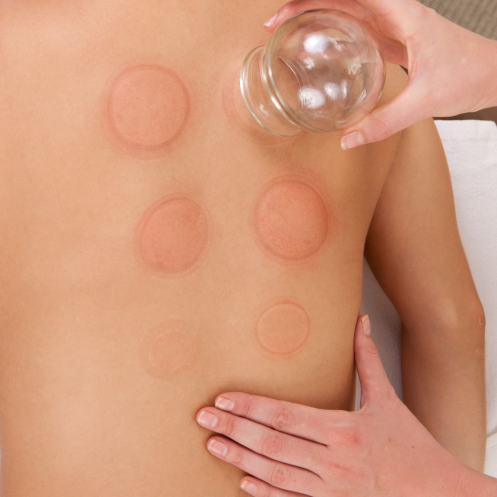 Cupping Therapy: What It Is, Why Everyone’s Talking About It, and If It’s Worth Trying