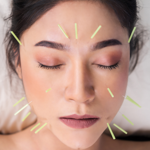 Facial Acupuncture: LifeCycles' Unique Approach