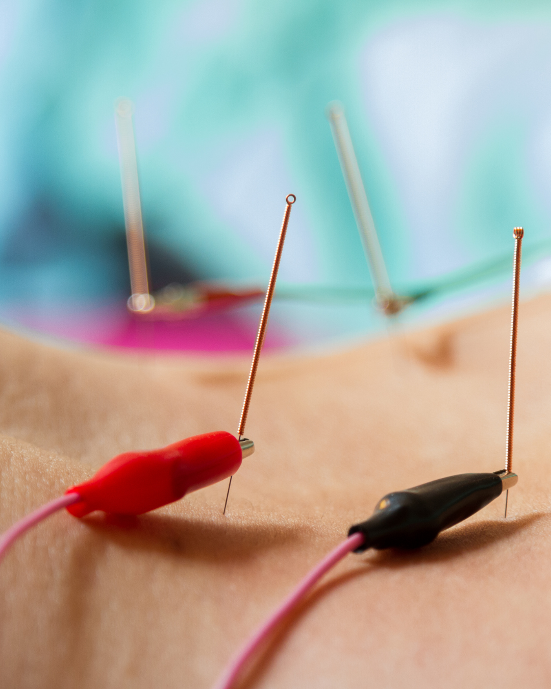 Electro Acupuncture: A Modern Twist on an Ancient Healing Technique