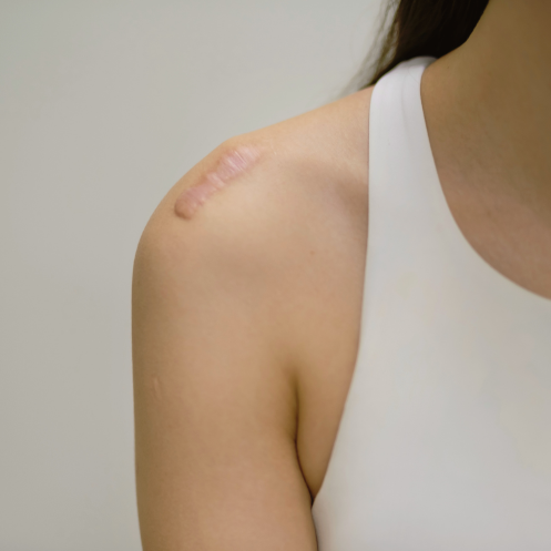 A Special Note About Keloid Scars