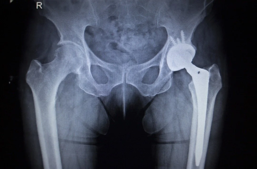 Osteoporosis + glyphosate 

Bone health is about more than calcium.

A January 2026 paper examined glyphosate exposure in relation to bone mineral density, osteoporosis, and fracture outcomes in the U.S. population.

We need more research, but it rai