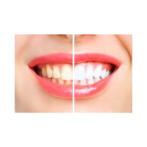 Close-up of a person's smile showing a comparison between stained, uneven teeth on the left and bright, clean teeth on the right.