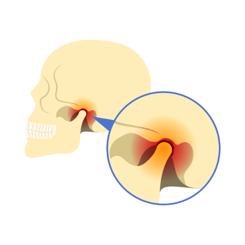 Illustration of a human skull showing sinus infection or inflammation in the nasal sinuses.