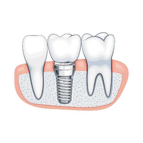 Diagram of dental implant in jawbone with surrounding teeth and gums.