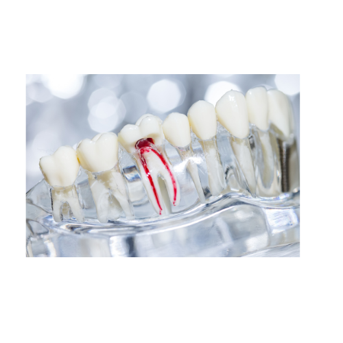 Dental model with a tooth undergoing a root canal procedure, showing the pulp chamber with red dye.
