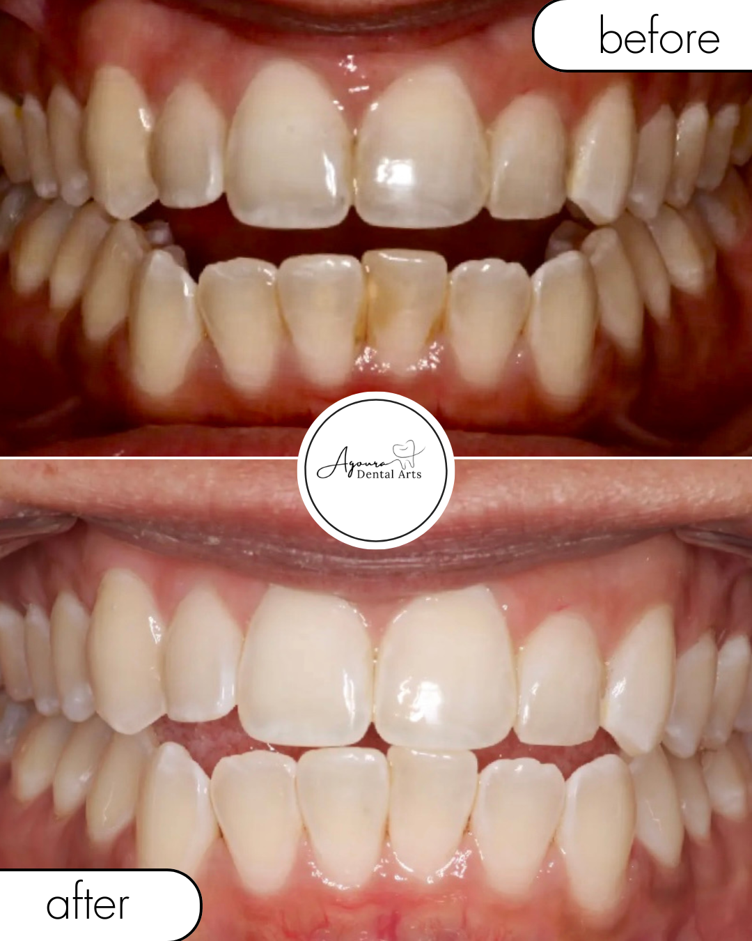 teeth cleaning and routine dental care before and after at agoura dental arts