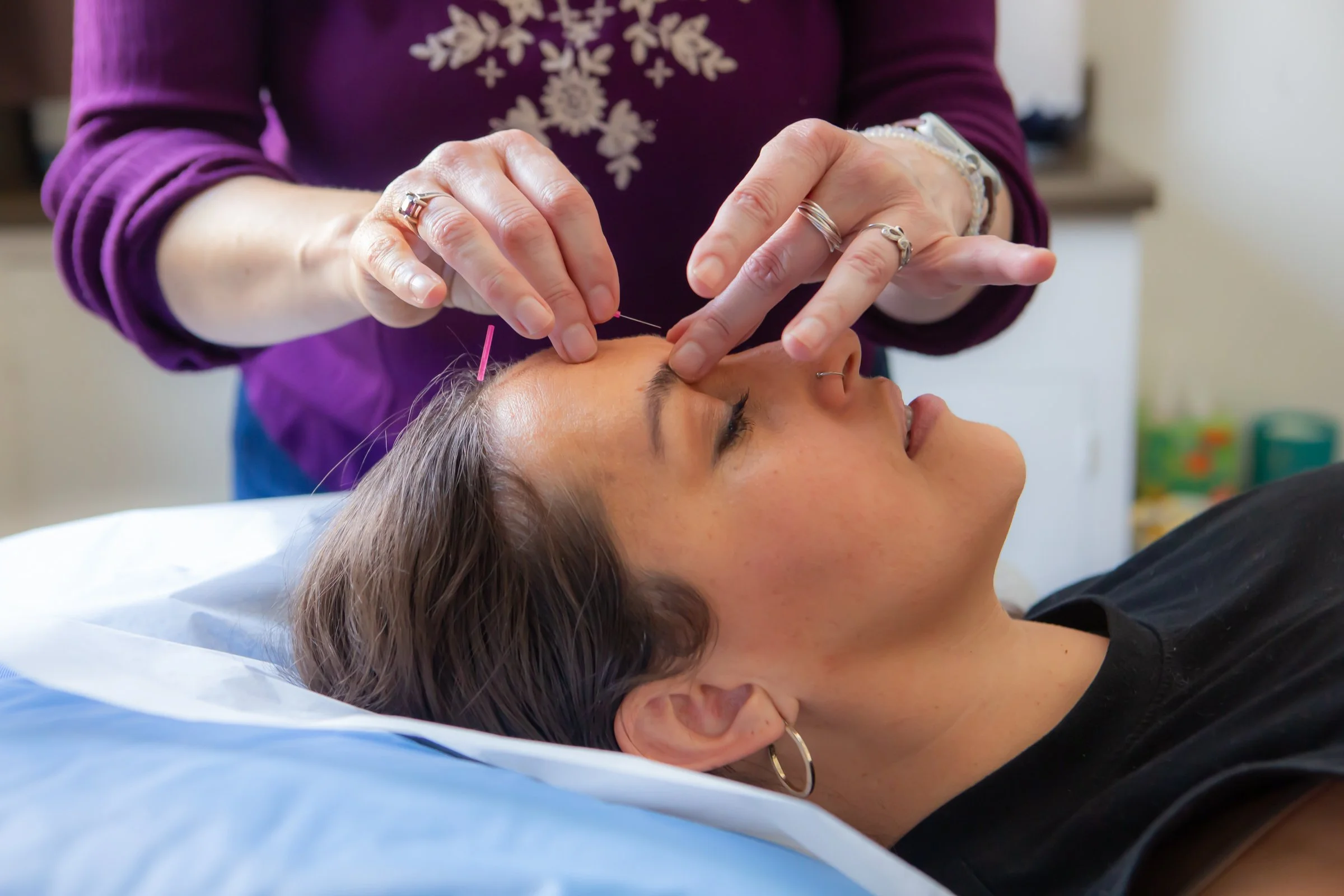 A woman is receiving acupuncture treatment, with thin needles inserted into her forehead while she lies on a massage table.