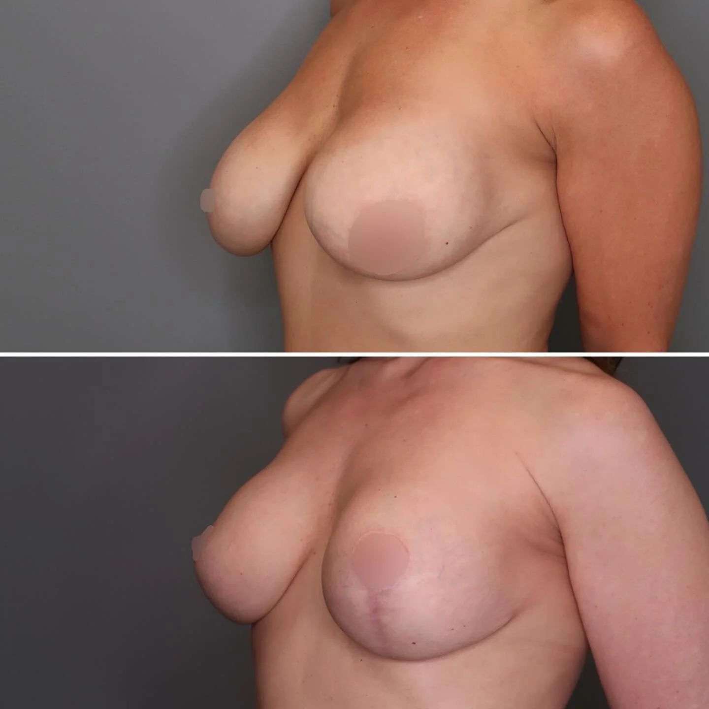 Replaced existing implants with a smaller size ✅⁣
⁣Mastopexy completed ✅⁣
⁣Repositioned nipples ✅⁣
⁣⁣
⁣This was revision surgery for a patient who was not happy with the result of surgery completed elsewhere. I was happy to help her achieve the resul