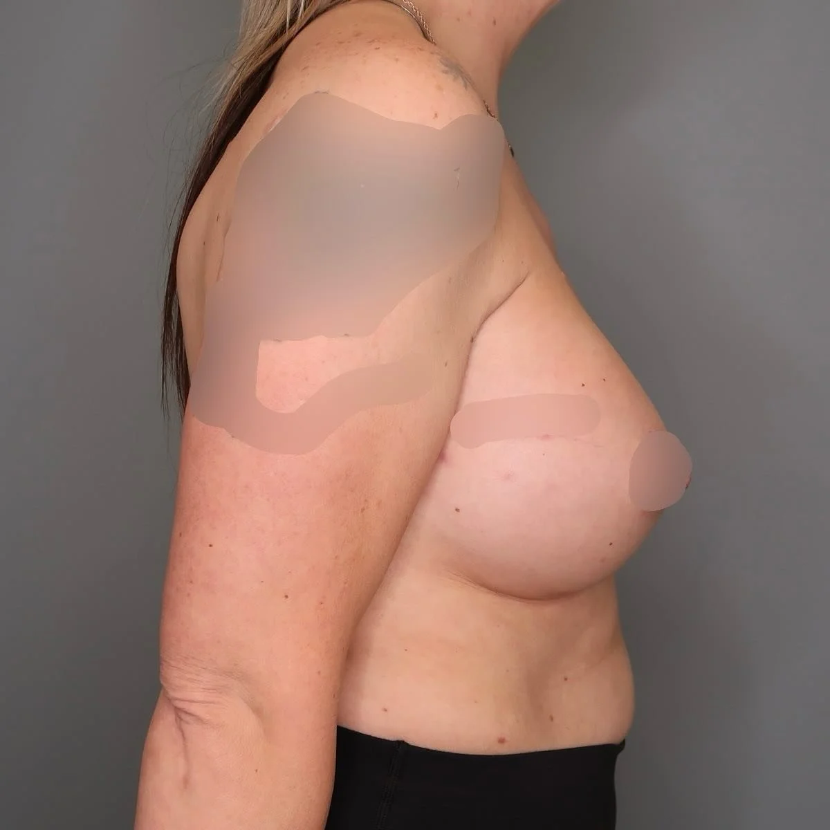 Before and After 👑 #saskatoon #beforeandafter #plasticsurgery #drchristhomson  Results may vary and are not guaranteed. ⁣
⁣