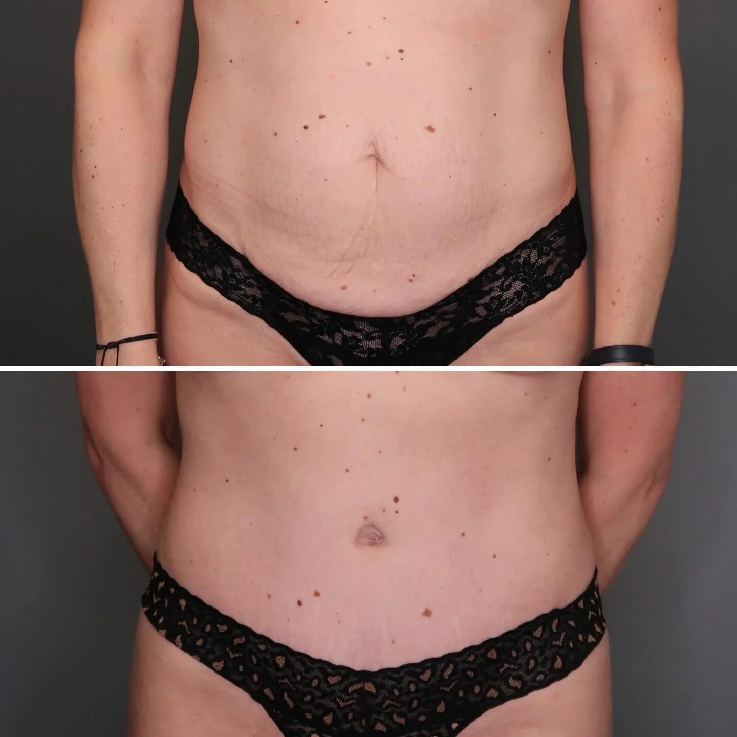 Abdominoplasty