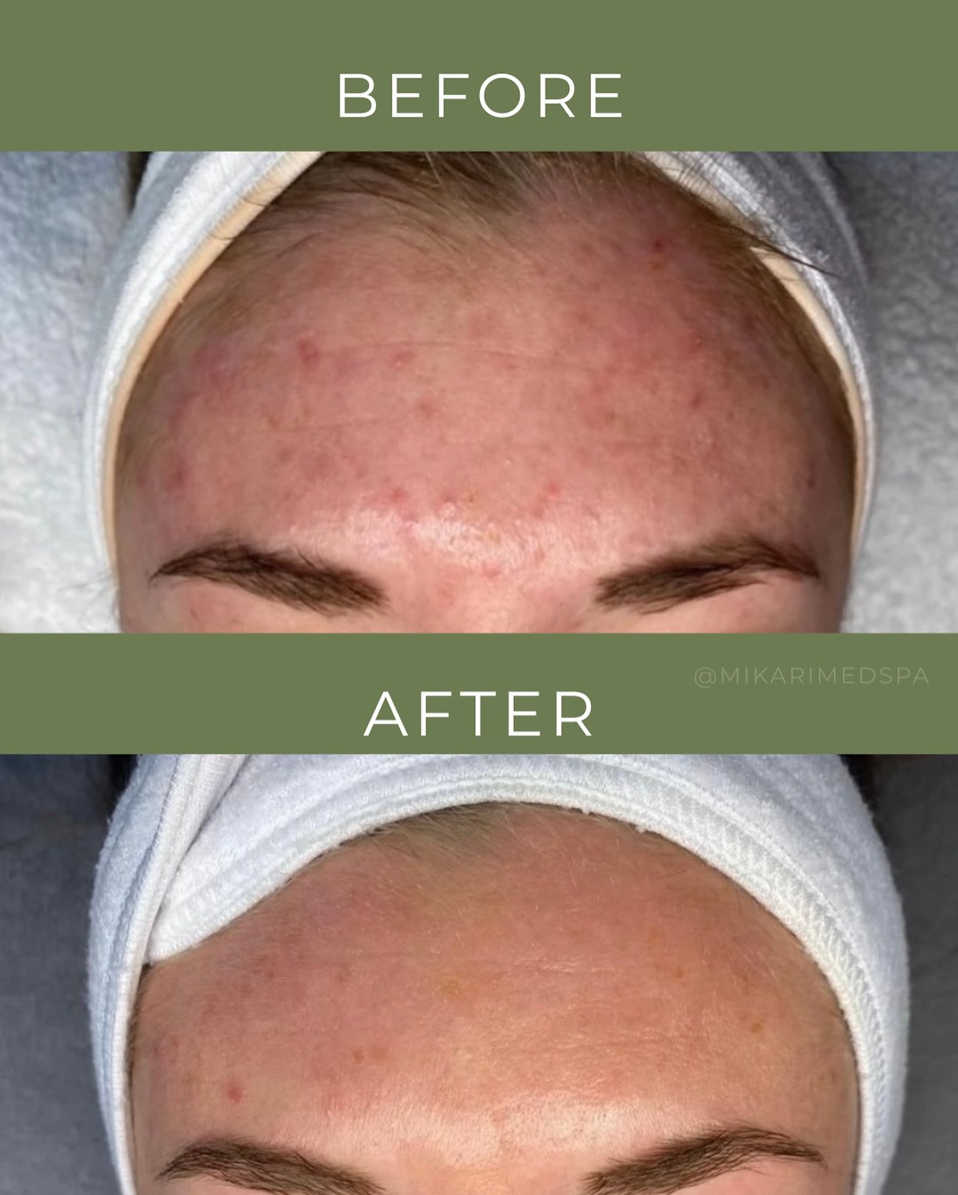 This can be you ✨ 1 month before and after!! After adopting simple lifestyle changes and working closely with our esthetician, this lovely lady is getting closer to achieving her skincare goals!
As much as we love to show you all our expertise and th