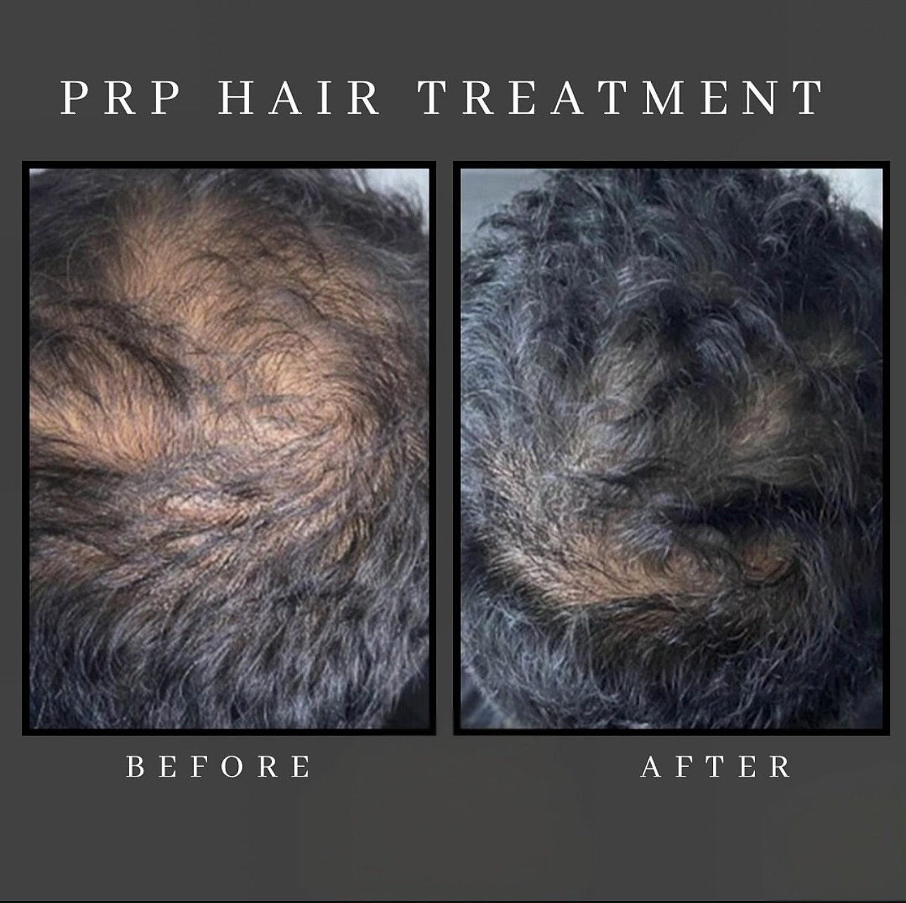 Results after three PRP hair treatments and we still have one more to go!
Have you considered PRP treatments for your hair thinning?
To schedule a consultation, visit the link in bio or DM us!

#arlingtonheights #prp #hairloss #beauty #medspa #integr