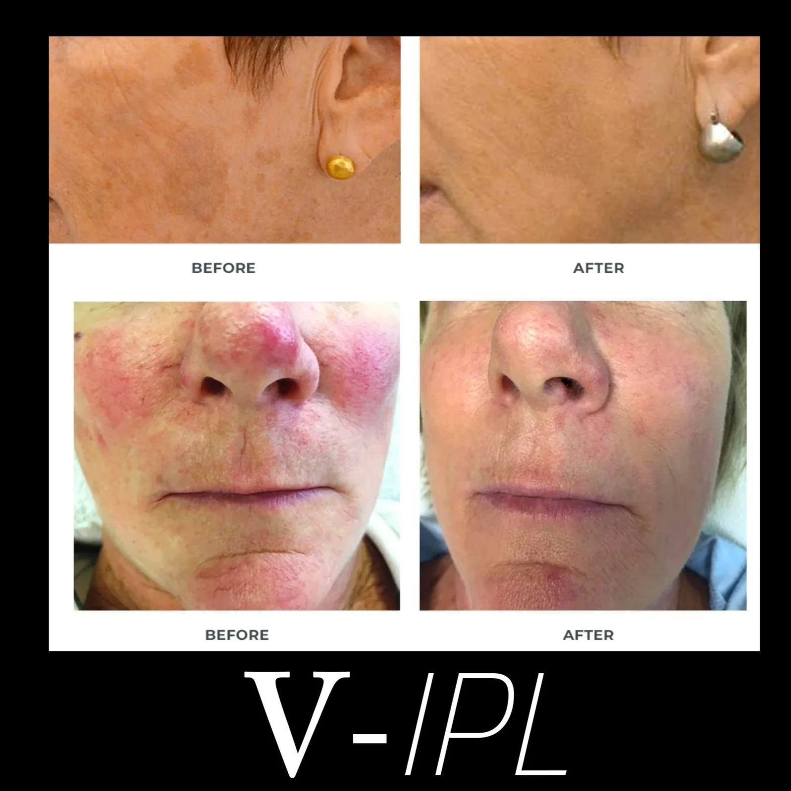 V-IPL+Face.jpg