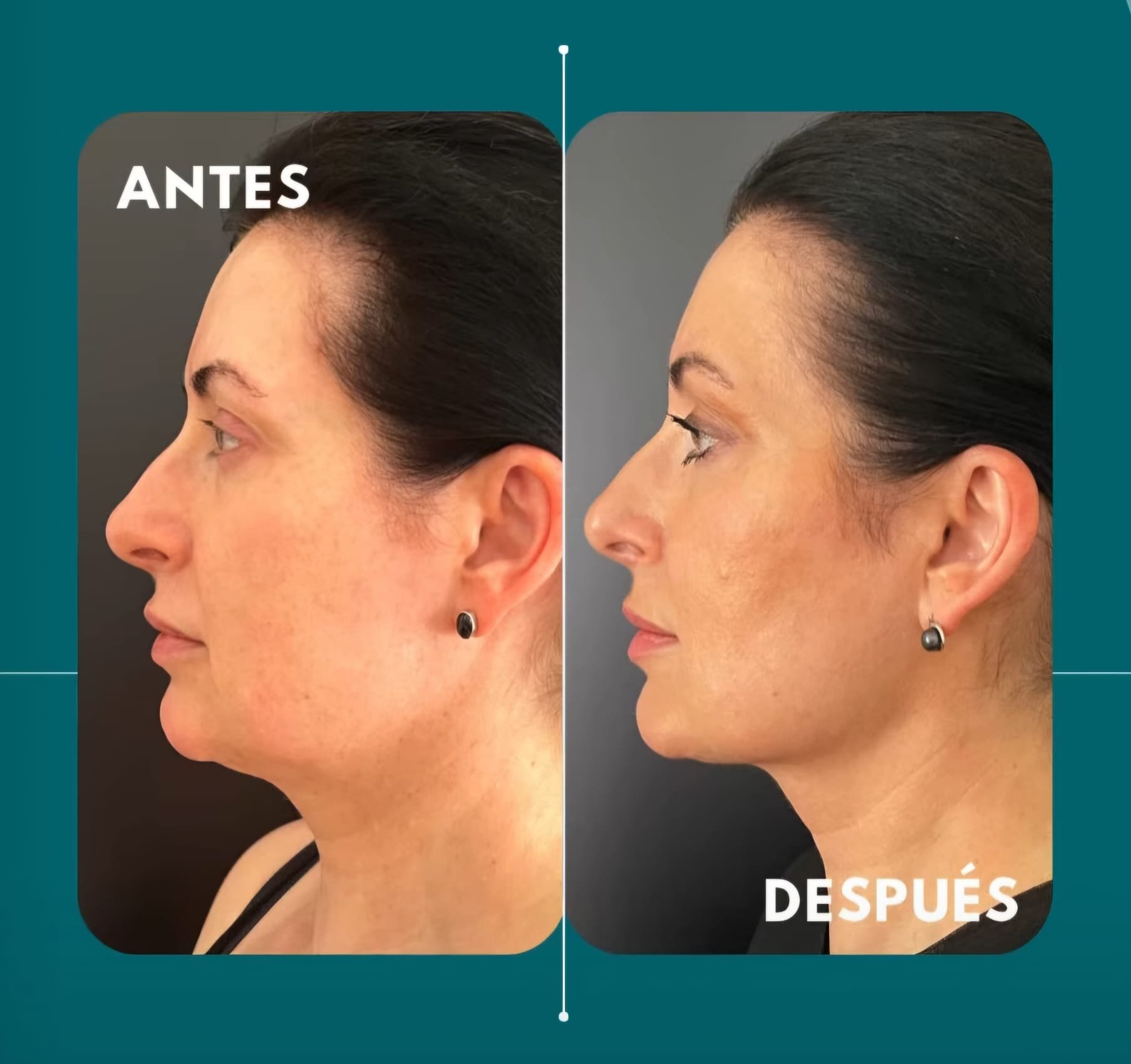 Comparación de rostro femenino antes y después de un tratamiento de belleza o cirugía estética, mostrando mejora en la piel y el perfil facial.
