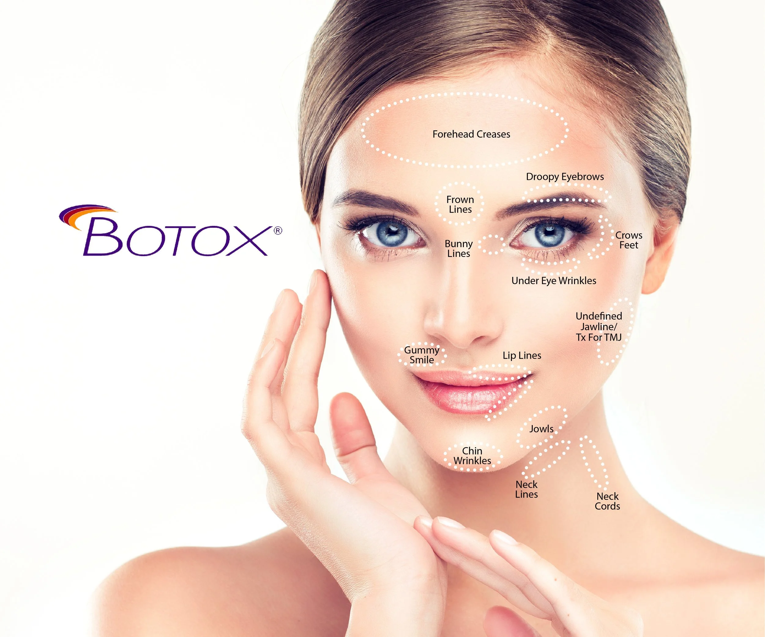 Diagram of a woman's face with white dotted outlines labeling common Botox treatment areas, including forehead creases, droopy eyebrows, frown lines, crows feet, bunny lines, under eye wrinkles, lip lines, jowls, chin wrinkles, neck lines, neck cords, gummy smile, and undefined jawline or temple area.