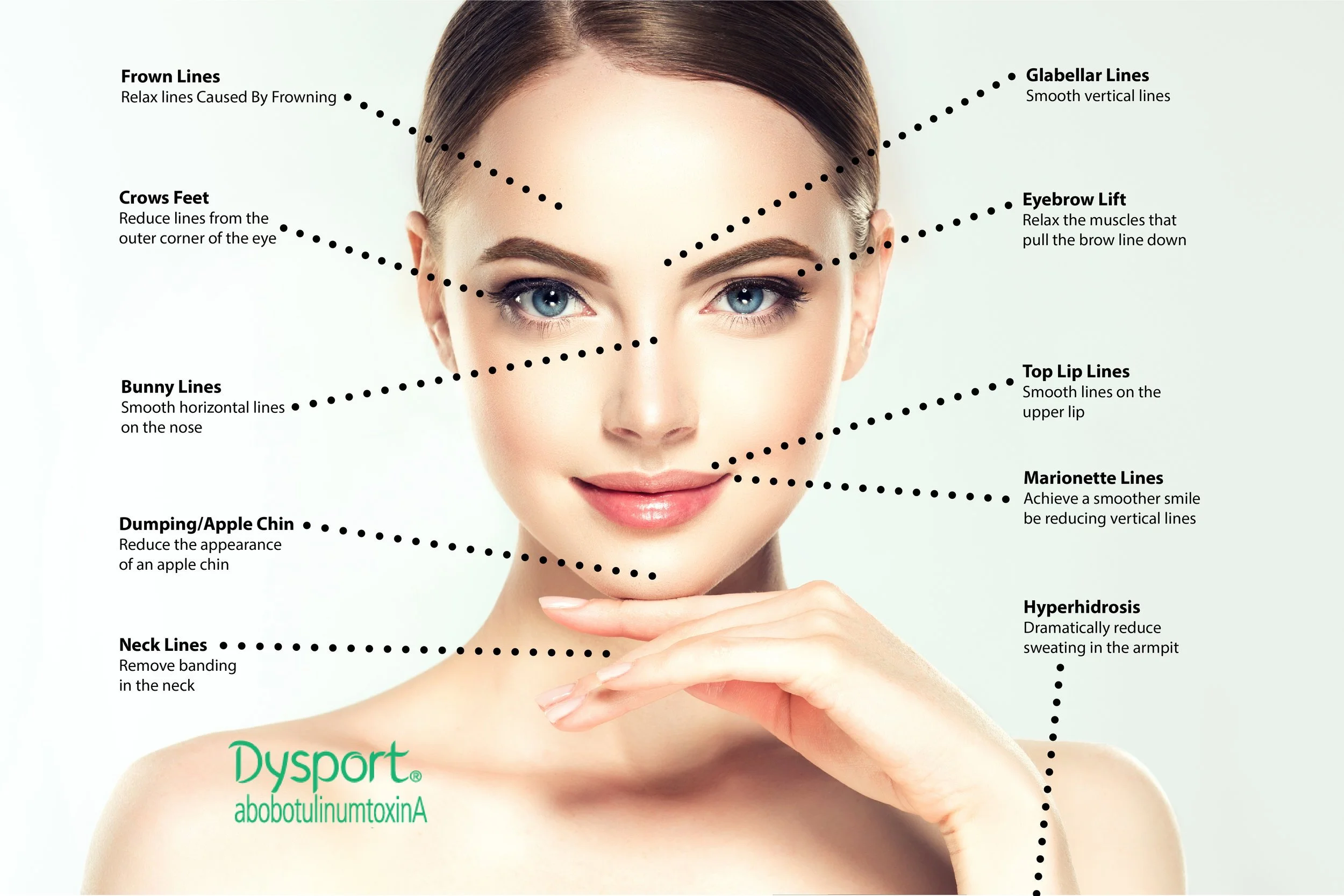 A woman with clear skin and blue eyes, with dotted lines and labels indicating various facial features and cosmetic concerns, such as forehead lines, crow's feet, bunny lines, dumping/apple chin, neck lines, glabellar lines, eyebrow lift, top lip lines, marionette lines, and hyperhidrosis, with a green logo at the bottom left reading 'Dysport abobotulinumtoxinA'.