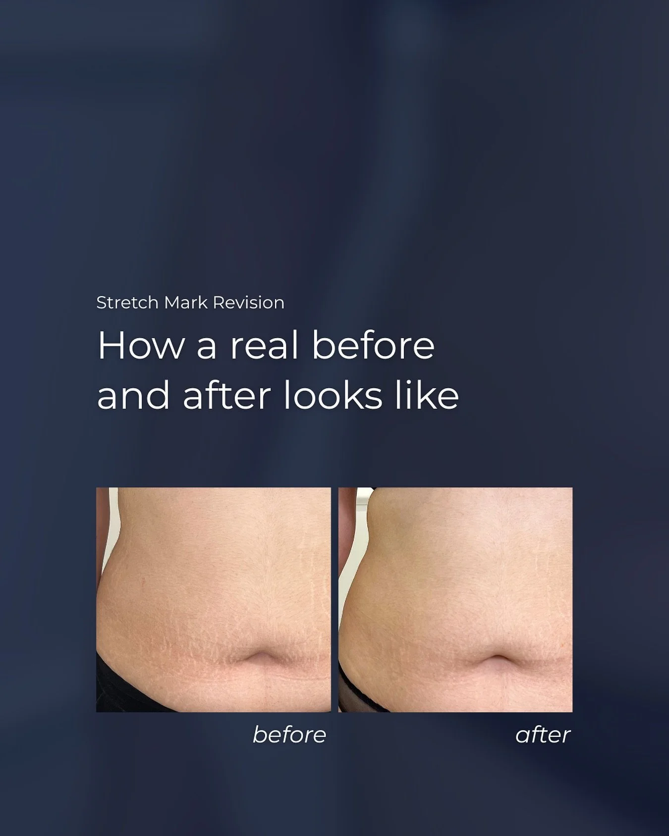 These are my client’s results after only 1 session. 
With advanced revision techniques, fading stretch marks naturally is completely possible. This is why I train others: to share a skill that transforms skin and, more importantly, the way peo